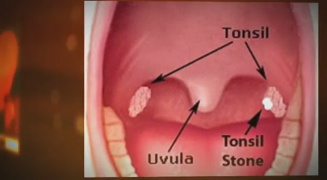 Tonsil Stones Remedy